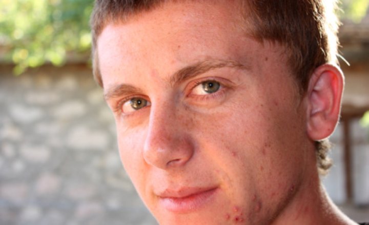 Foto von Jugendlichem mit Akne